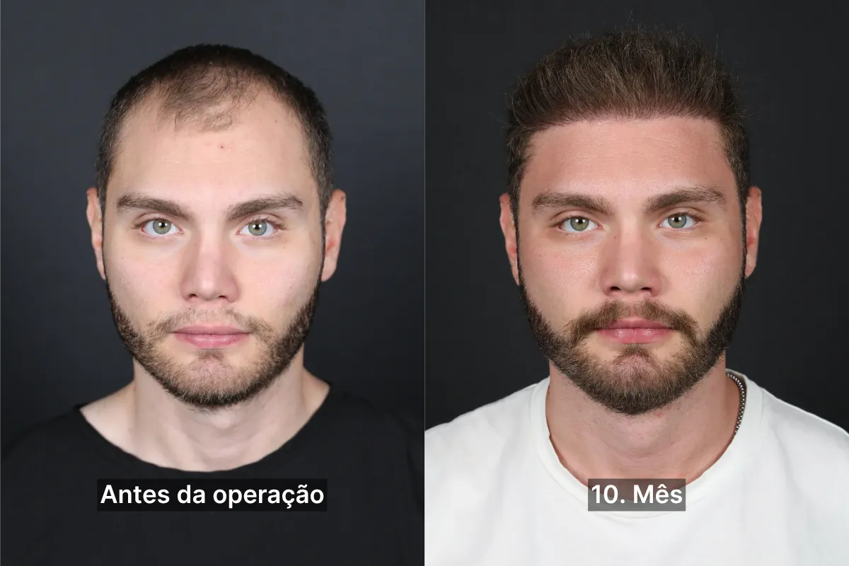 10ay1pt