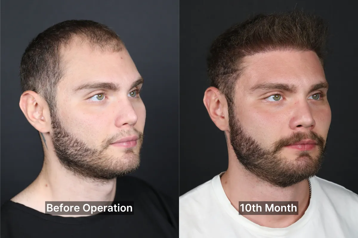 10ay2