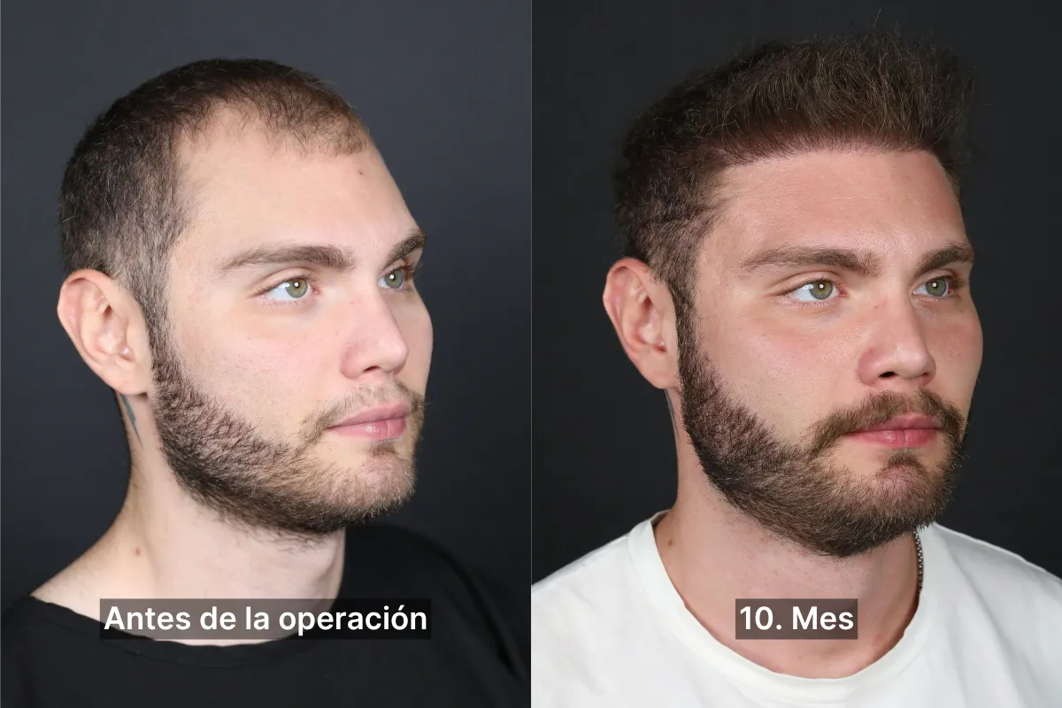10ay2es