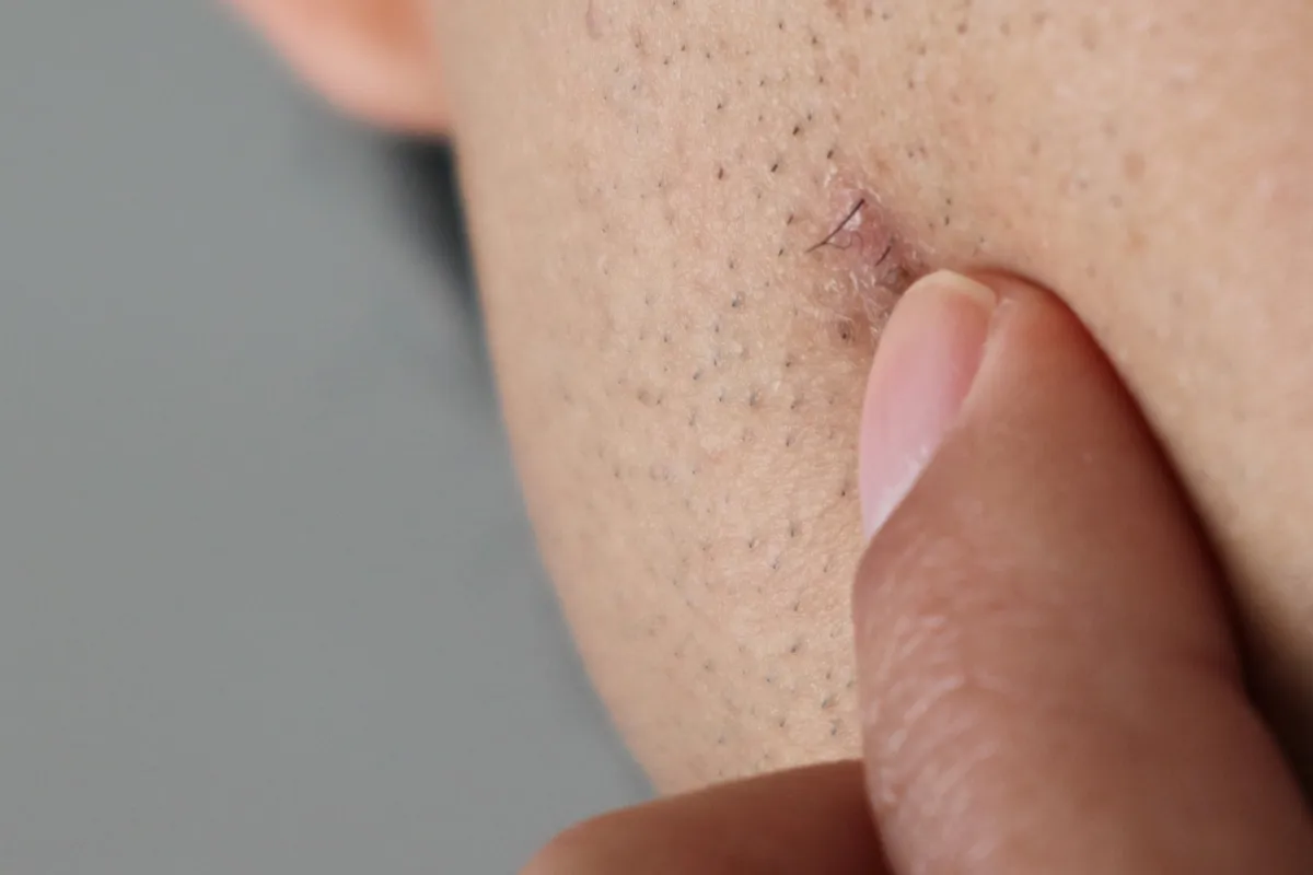 Ingrown Hair Full Treatment and Prevention Guide 1