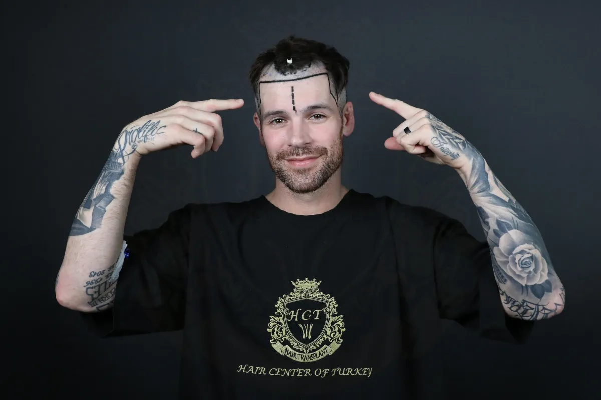 Best Countries for Hair Transplant in 2025 2