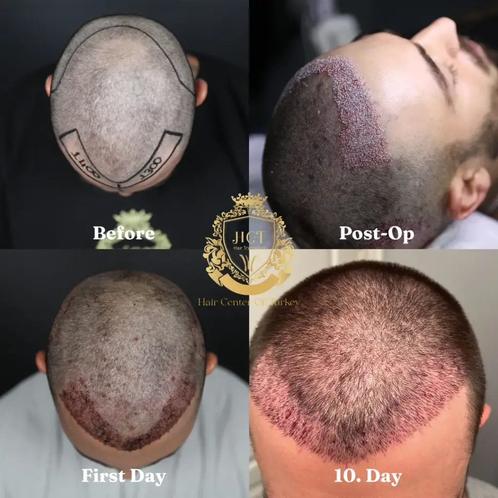 Can I Go To Work After a Hair Transplant F_result