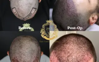 Can I Go To Work After a Hair Transplant F_result
