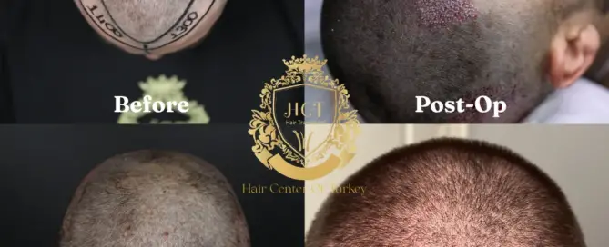 Can I Go To Work After a Hair Transplant F_result