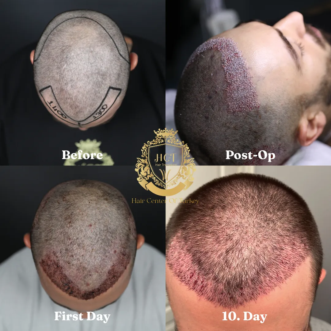 Can I Go To Work After a Hair Transplant F_result