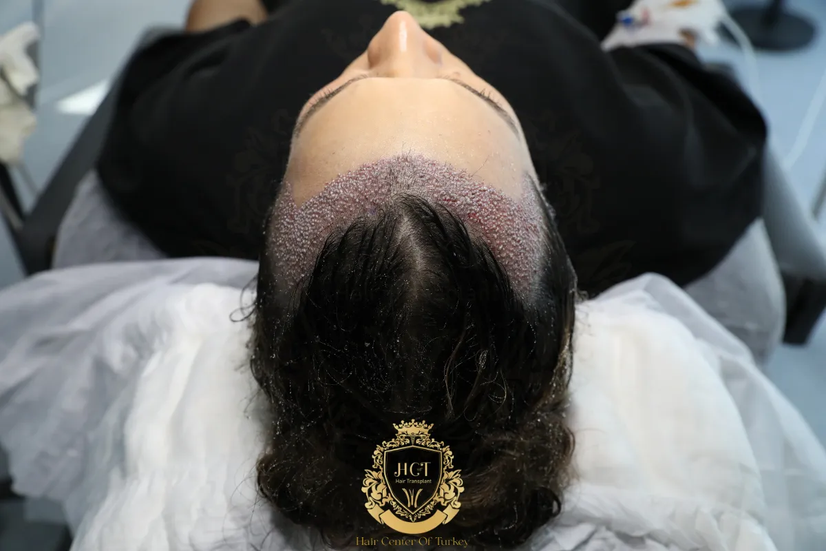 Hair Transplant Australia vs Turkey Which Destination Offers Better Value and Results 3