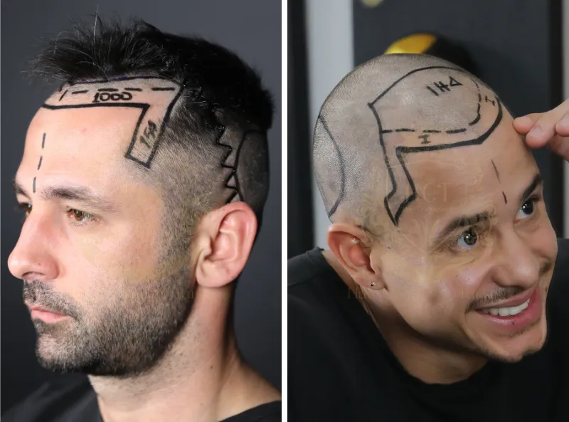 Hair Transplant Without Shaving 1 Hair Transplant Without Shaving