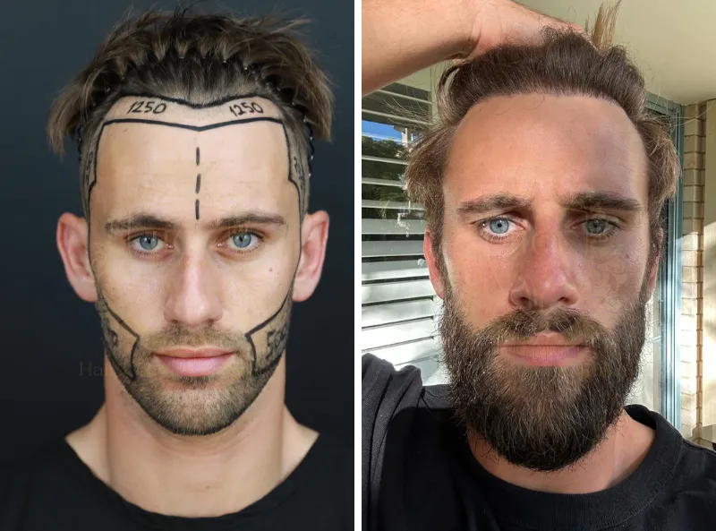 Hair Transplant Without Shaving 2 Hair Transplant Without Shaving