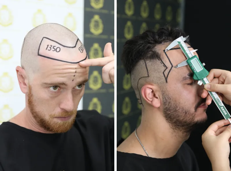 Haartransplantation ohne Rasur 3 Haartransplantation ohne Rasur