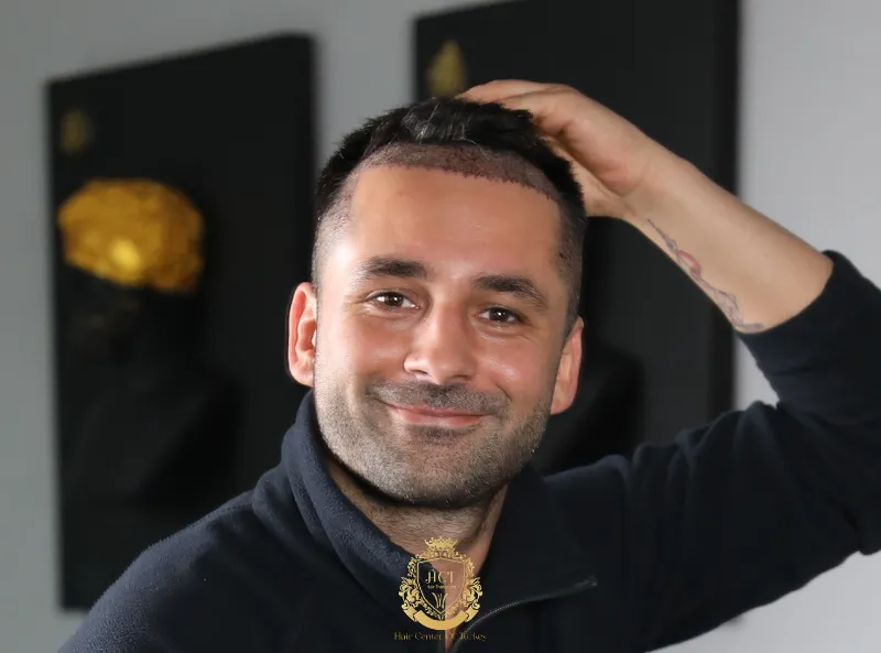 Haartransplantation ohne Rasur 6 Haartransplantation ohne Rasur