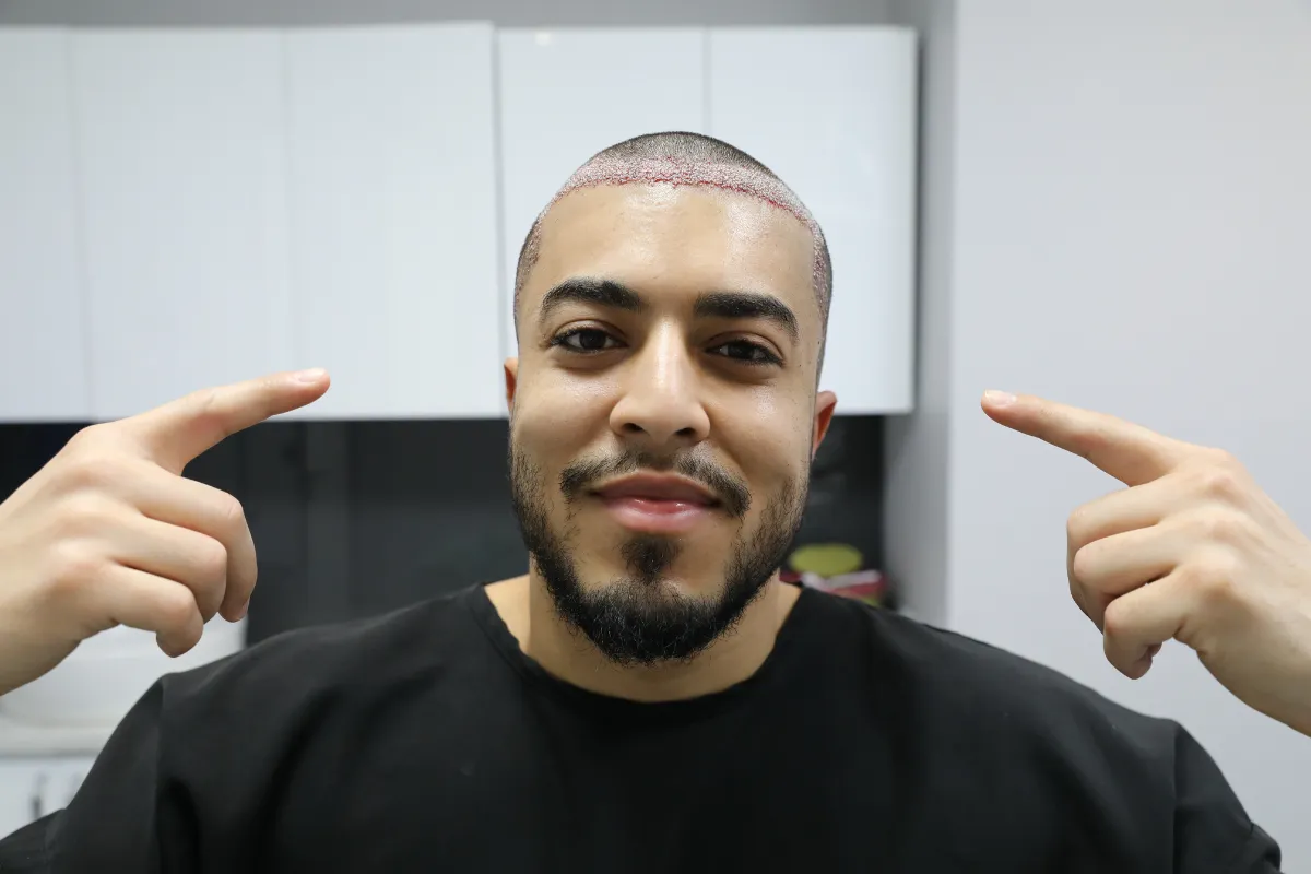 How Can You Maximize FUE Hair Survival Effectively 1