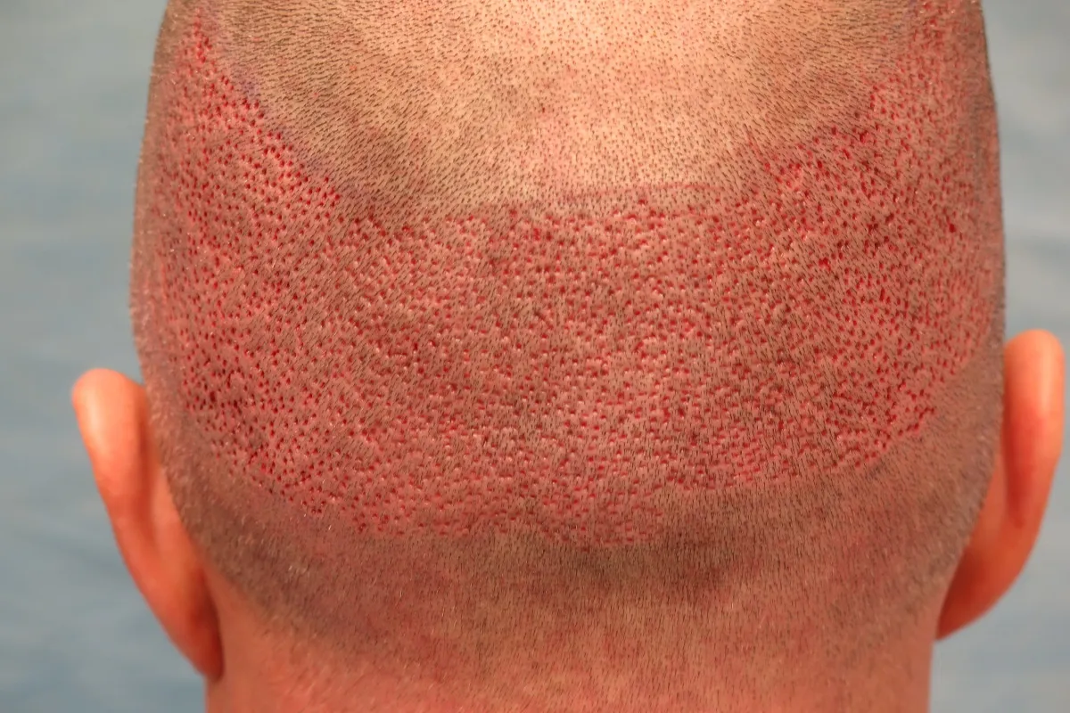How Can You Maximize FUE Hair Survival Effectively 2