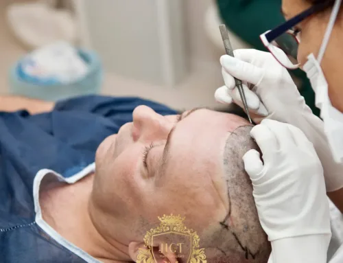 Hoe kunt u de overlevingskansen van FUE-haar effectief maximaliseren?