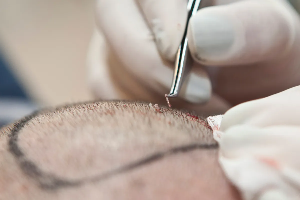 How Long Do Hair Transplant Results Last and Are They Permanent 1