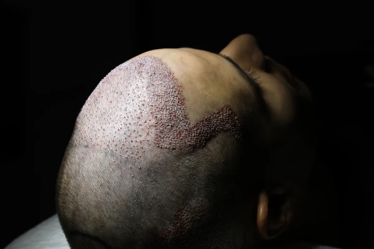 How Long Do Hair Transplant Results Last and Are They Permanent 2