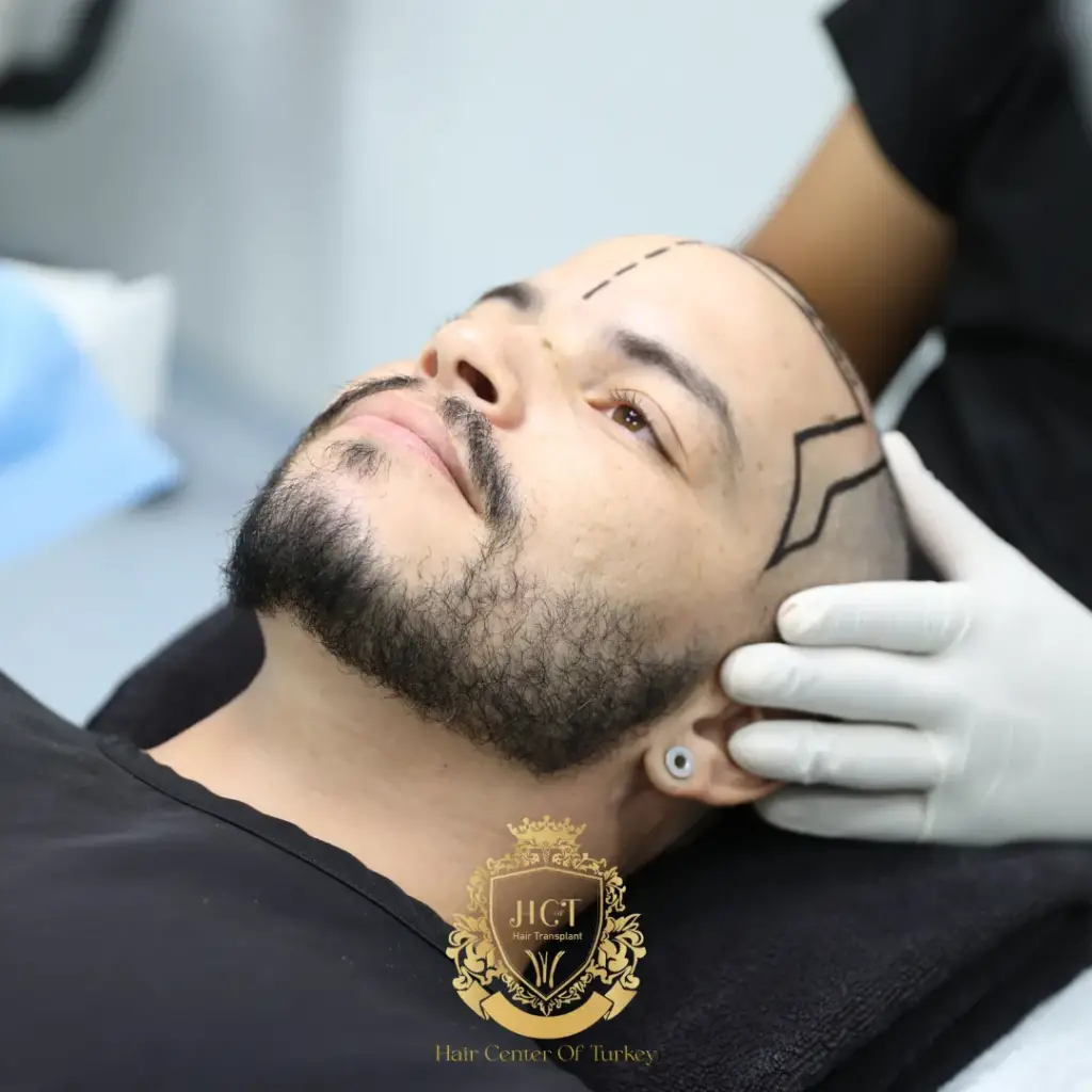 How Long Do Hair Transplant Results Last and Are They Permanent f