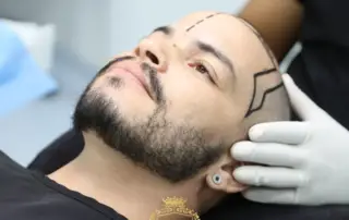 How Long Do Hair Transplant Results Last and Are They Permanent f