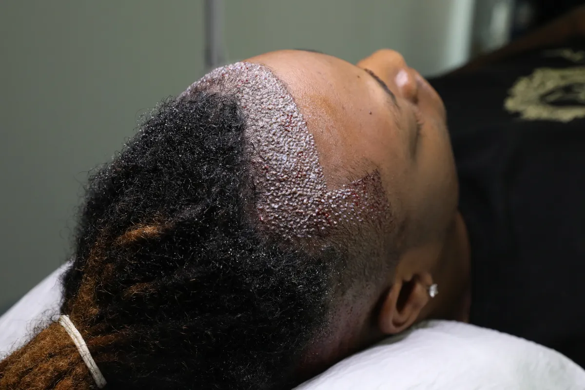 How to Choose the Best Hair Transplant Surgeon in America 3