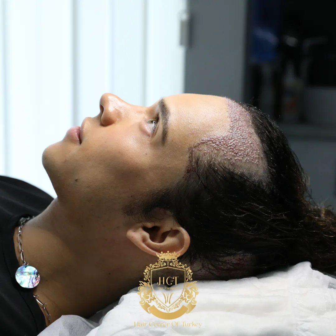 How to Choose the Best Hair Transplant Surgeon in America F