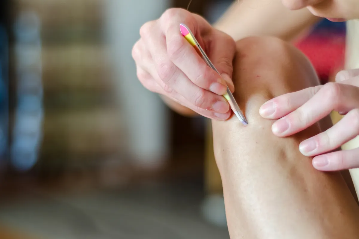 Ingrown Hair Full Treatment and Prevention Guide 2