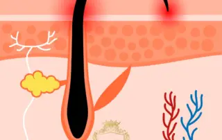 Ingrown Hair Full Treatment and Prevention Guide F