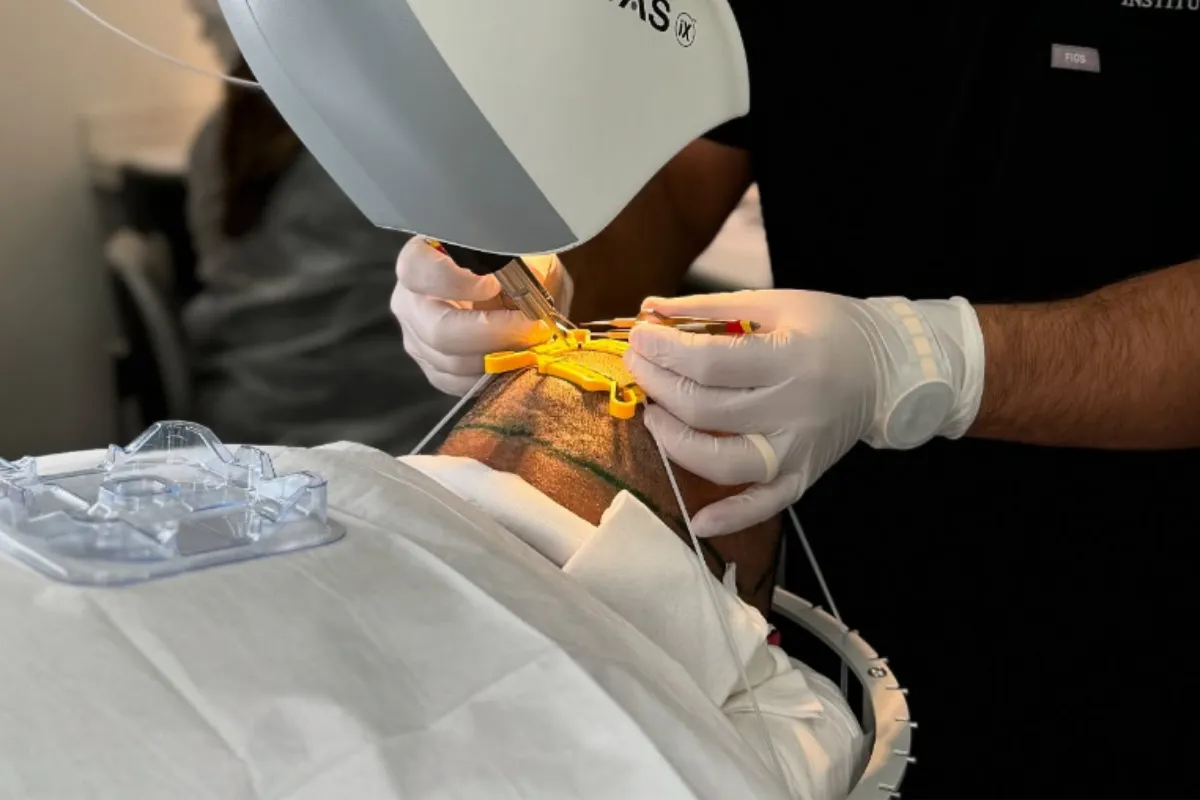 Is ARTAS Robotic Transplant the Best Way to Restore Natural Hair 2