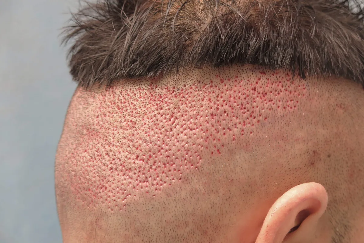Is ARTAS Robotic Transplant the Best Way to Restore Natural Hair 3