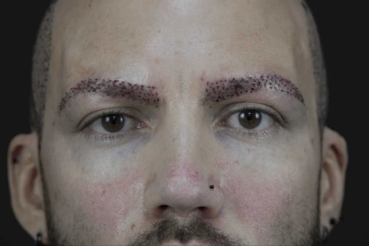 Is Eyebrow Transplant or Microblading Better 2