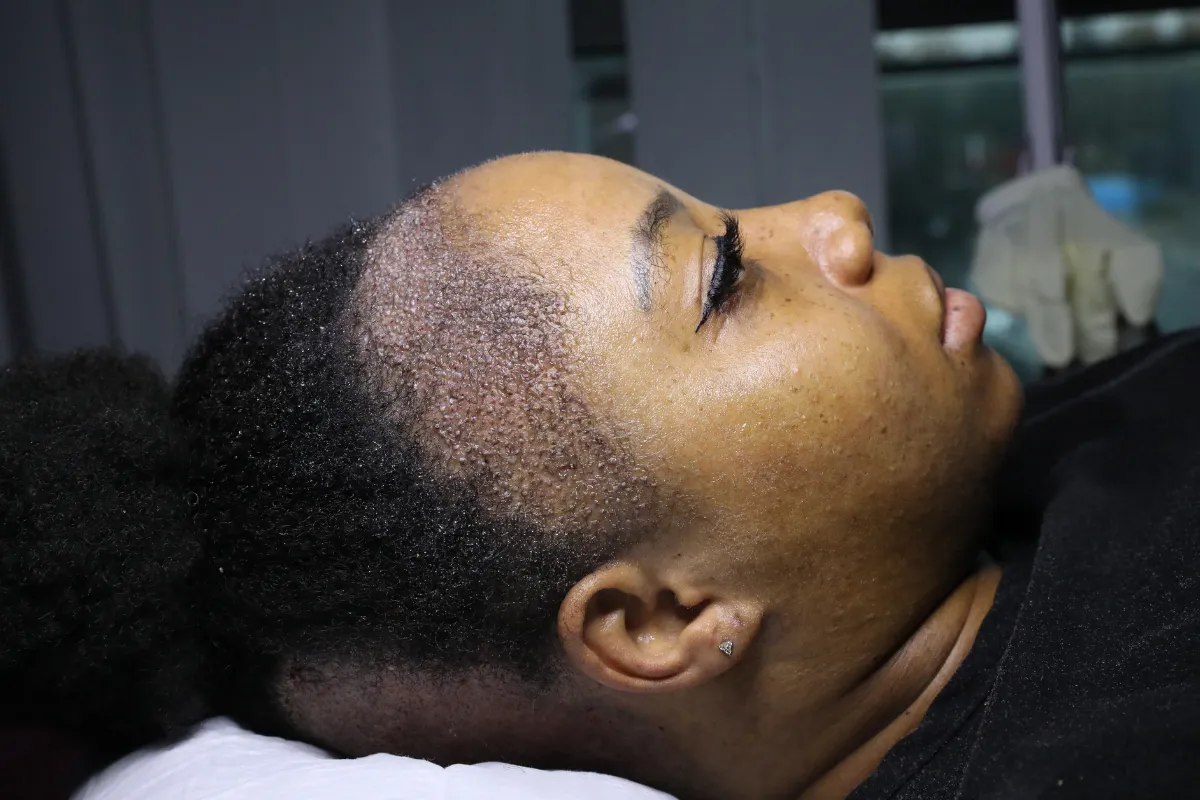 Is It Possible to Change Your Hair Texture With a Hair Transplant 3