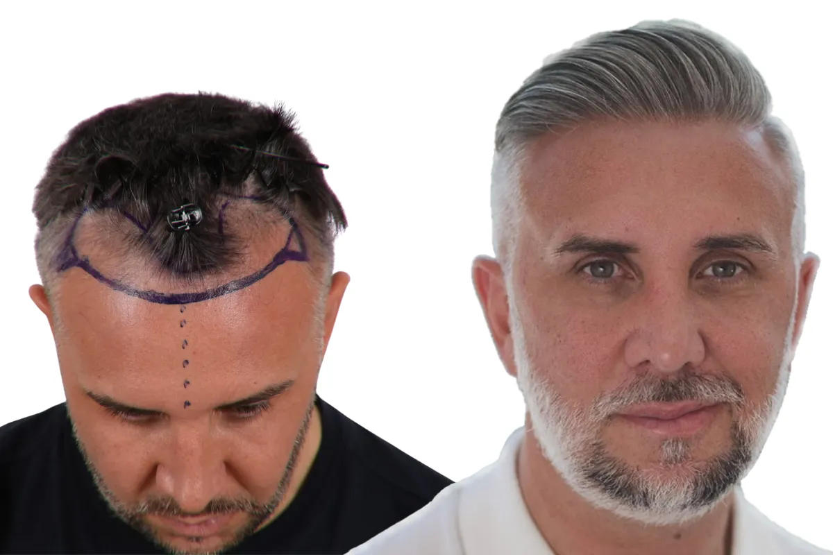 Keiran Lee Hair Transplant A Bold New Chapter in Confidence 2