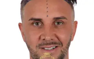 Keiran Lee Hair Transplant A Bold New Chapter in Confidence F