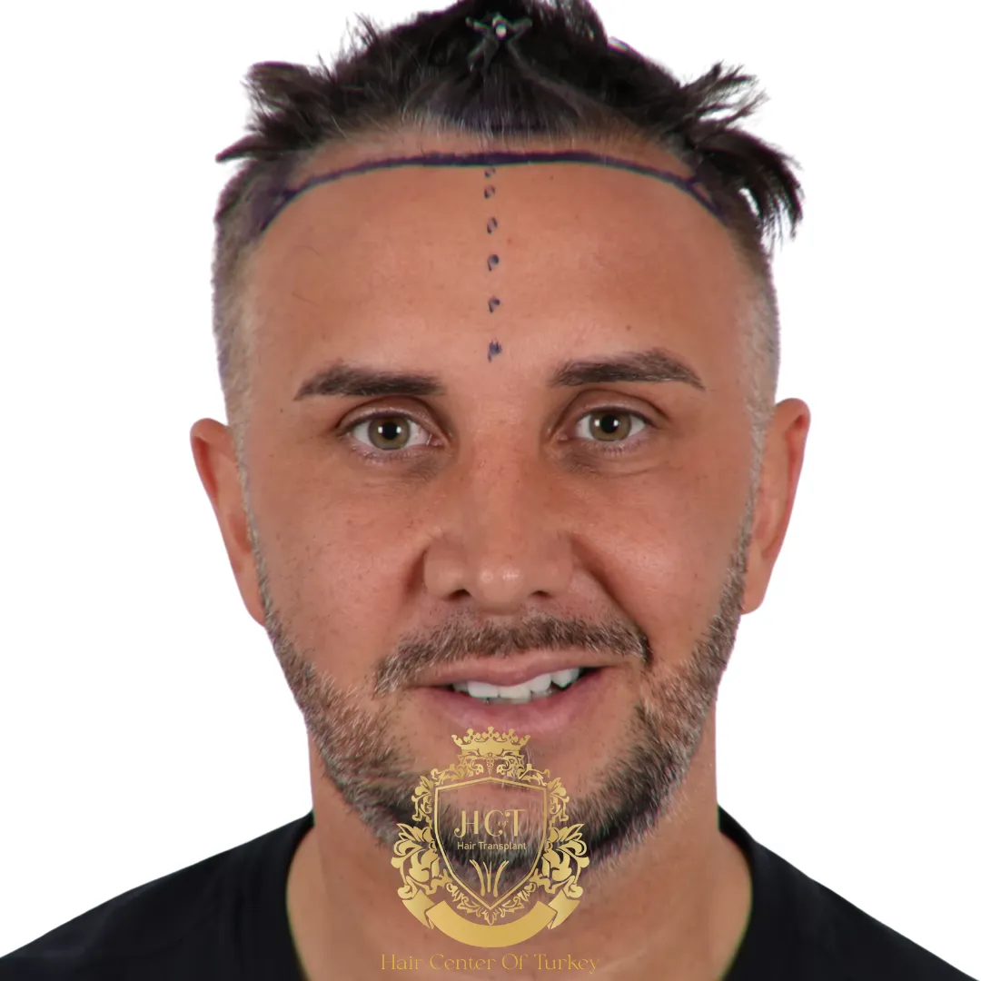 Keiran Lee Hair Transplant A Bold New Chapter in Confidence F