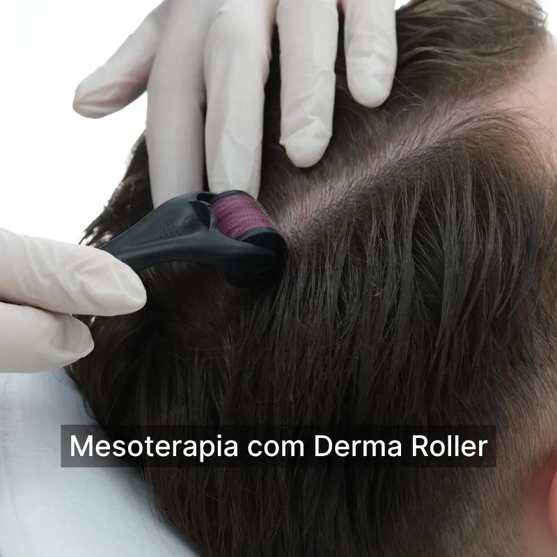 Mesoterapia com Derma Roller pt21231