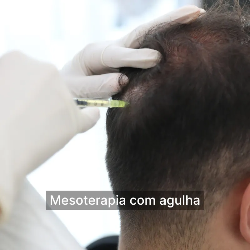 Mesoterapia com agulha pt