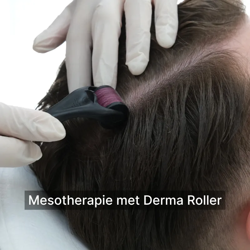 Mesotherapie met Derma Roller du 1