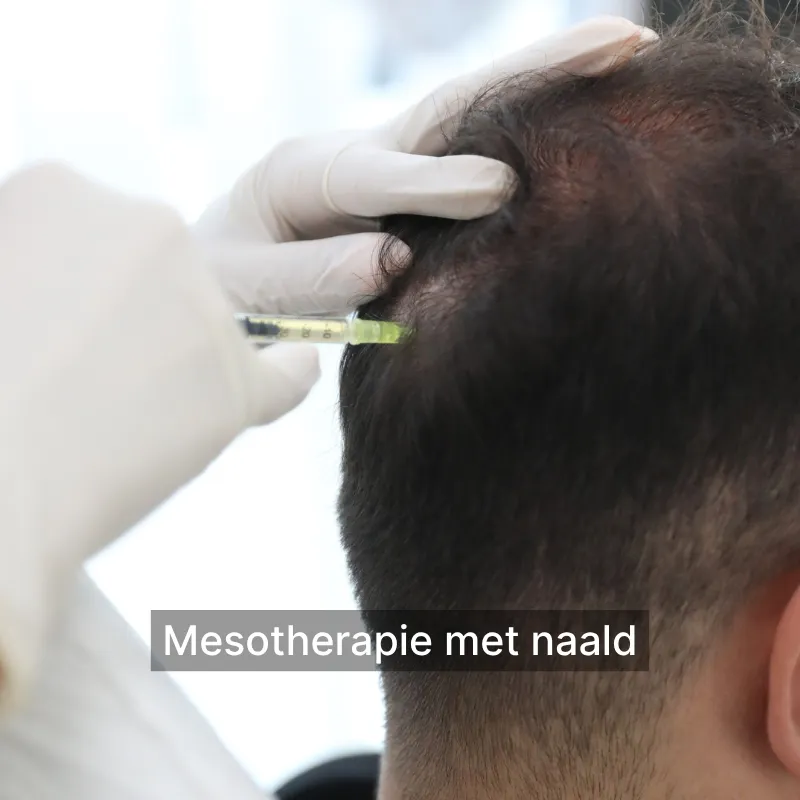 Mesotherapie met naald du