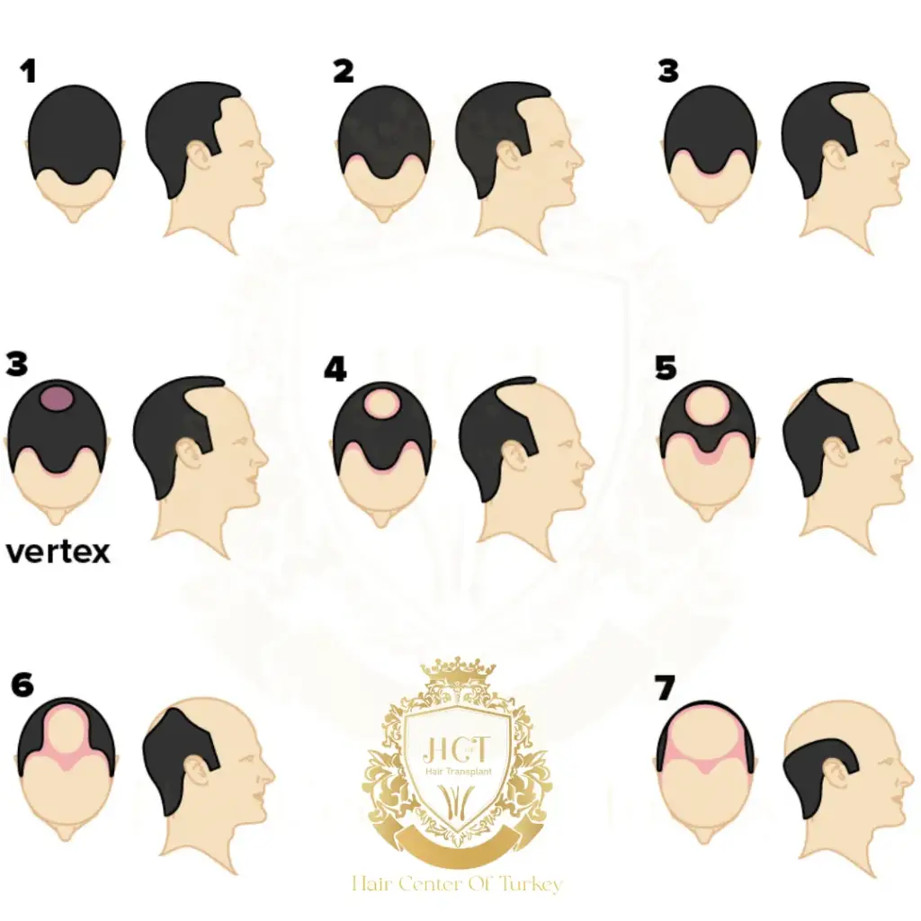 Norwood 1 Hair Loss F