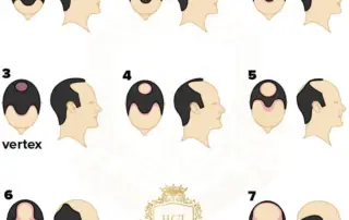 Norwood 1 Hair Loss F