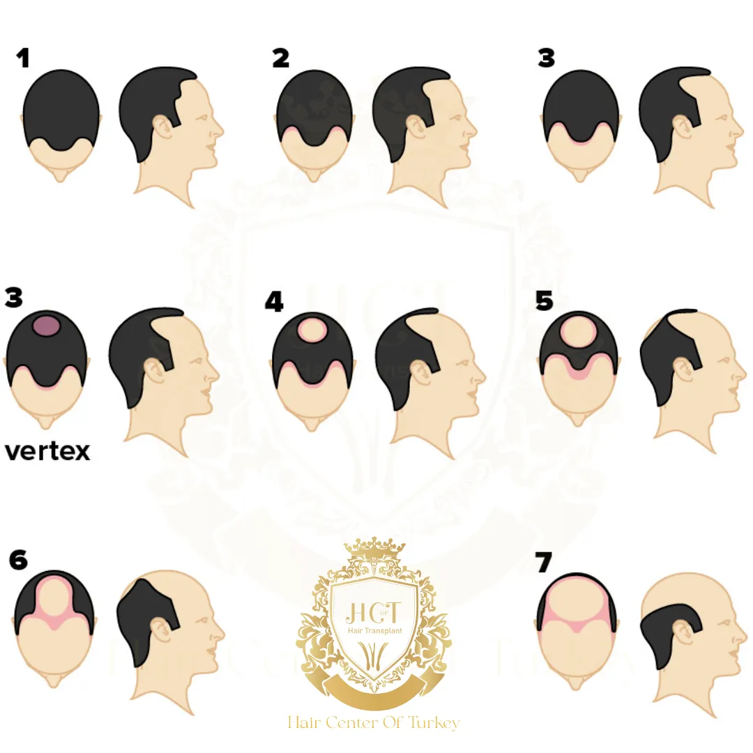 Norwood 1 Hair Loss F