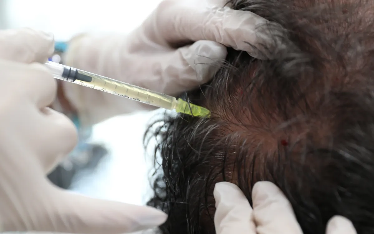 PRP Treatment at Hair Center of Turkey