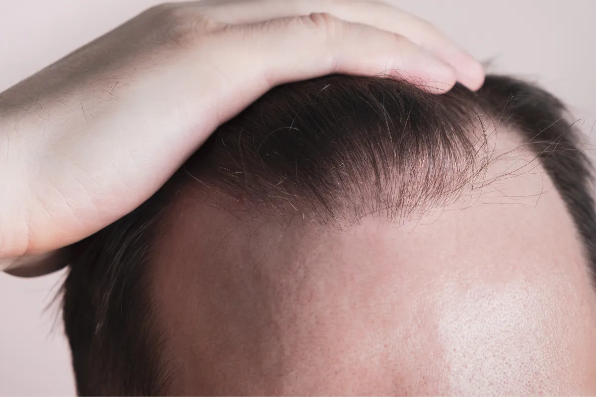 What Are the Best Hair Transplant Techniques for Different Hair Loss Types 1