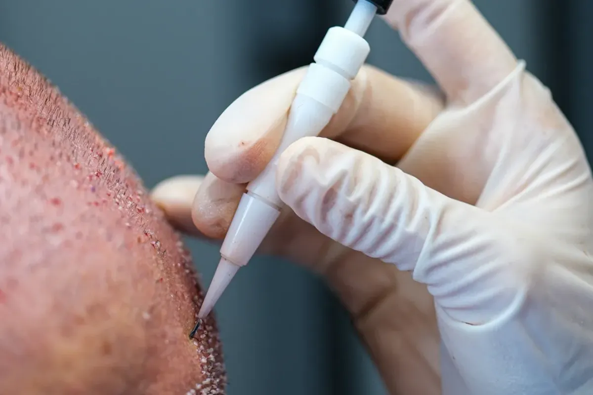 What Are the Best Hair Transplant Techniques for Different Hair Loss Types 2