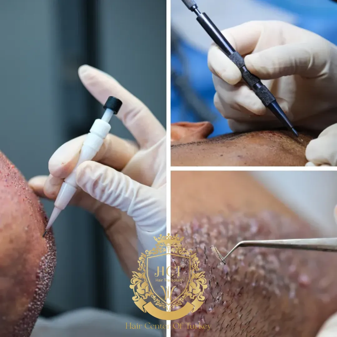 What Are the Best Hair Transplant Techniques for Different Hair Loss Types f