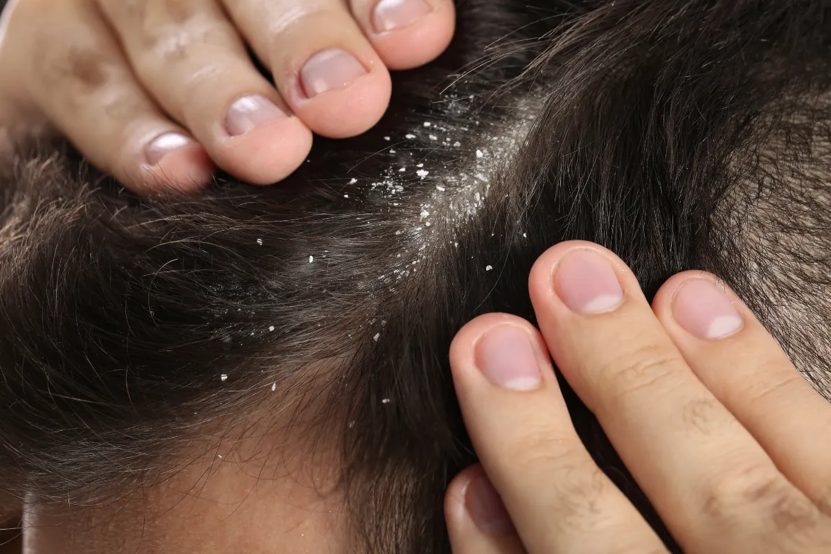 What Are the Most Common Hair Problems and How Can You Fix Them 3