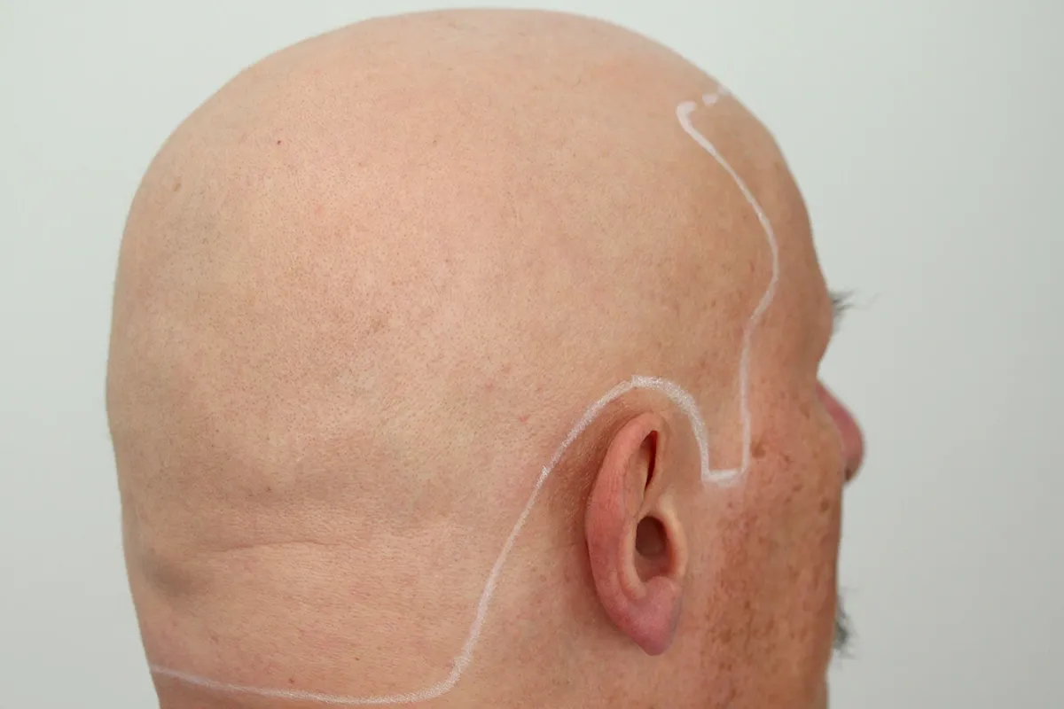 What Is Alopecia Totalis and What Are Its Symptoms and Causes 2
