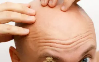What Is Alopecia Totalis and What Are Its Symptoms and Causes F