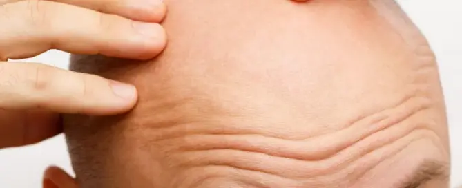 Qu'est-ce que l'alopécie totale, quels sont ses symptômes et ses causes ?