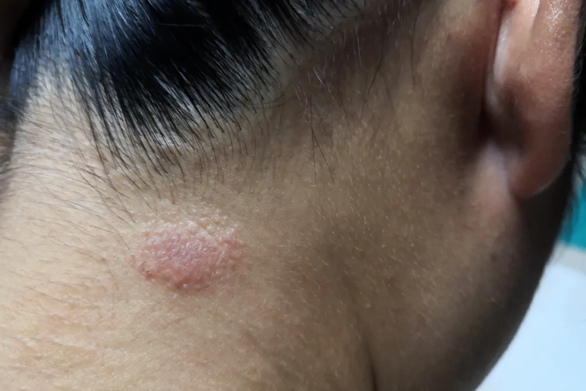 What Is Tinea Capitis and How Can It Be Treated 1