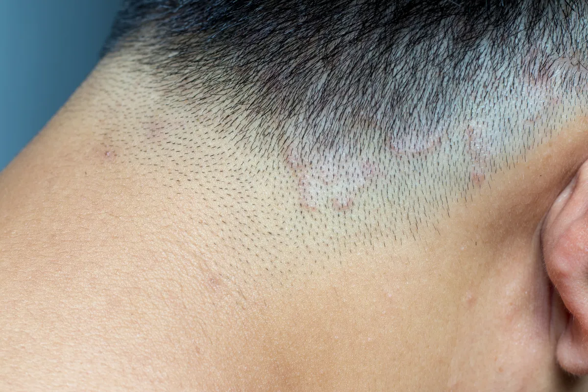 What Is Tinea Capitis and How Can It Be Treated 2