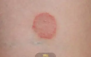 What Is Tinea Capitis and How Can It Be Treated F